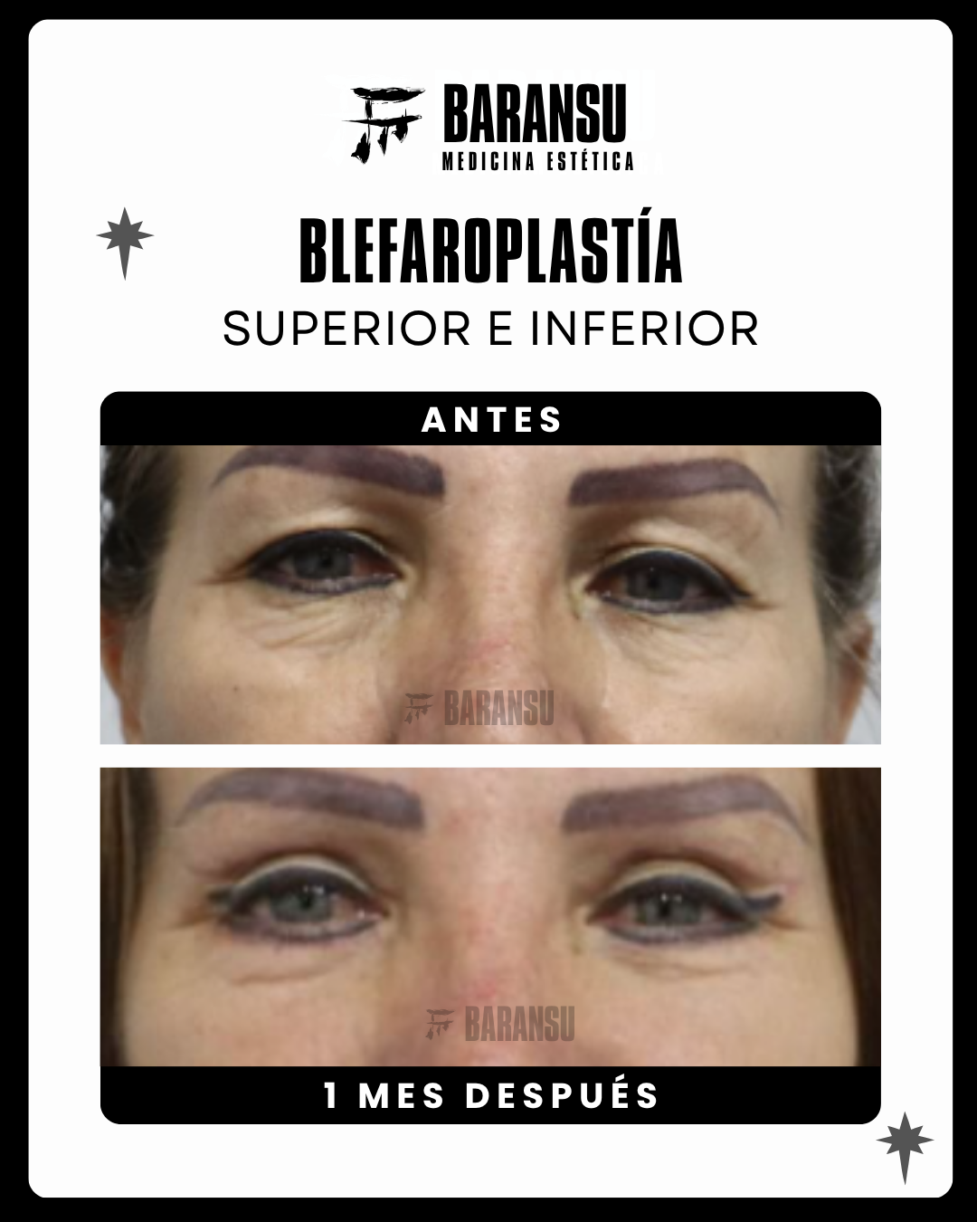 blefaroplastia 6
