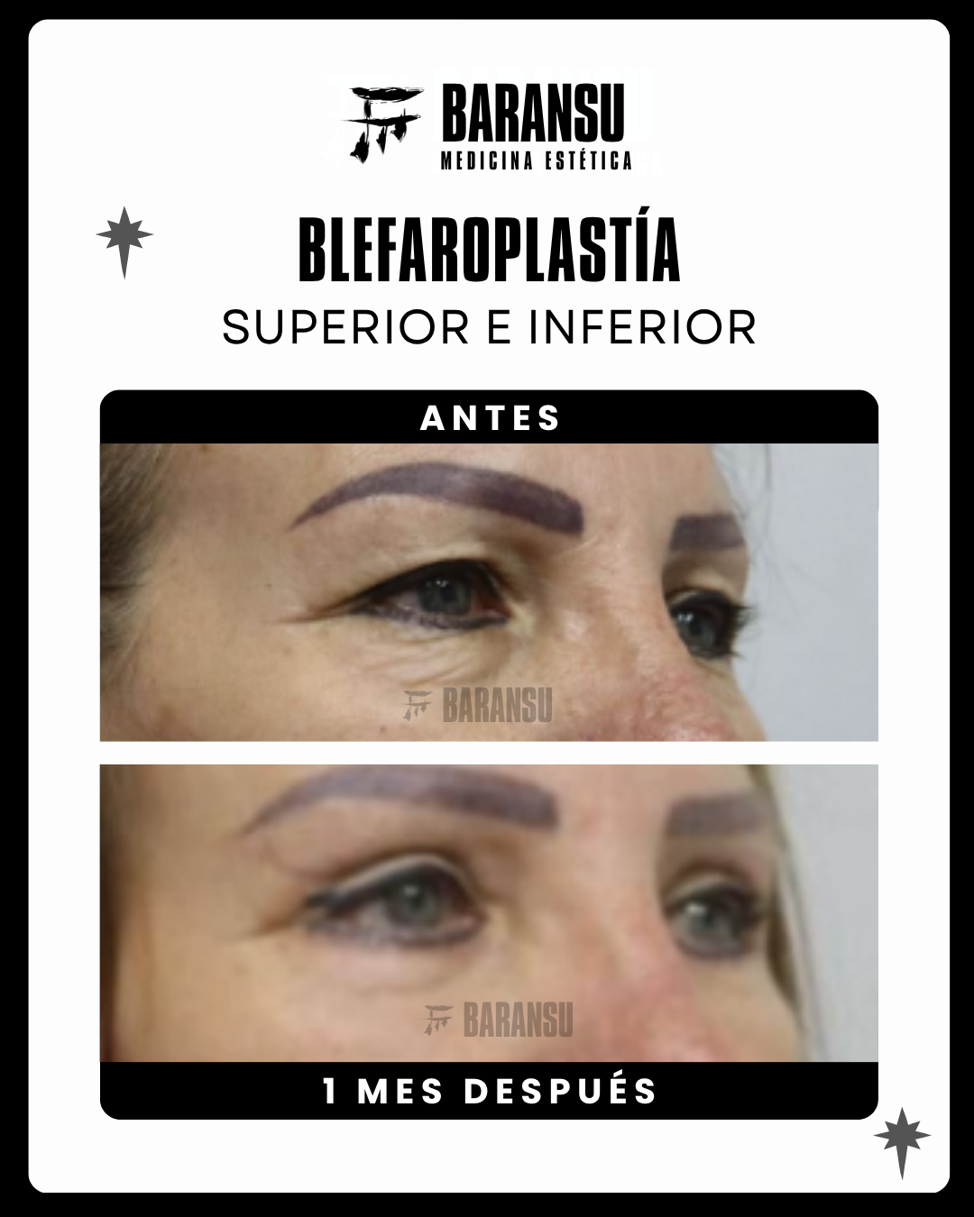 Blefaroplastía Superior E Inferior  8