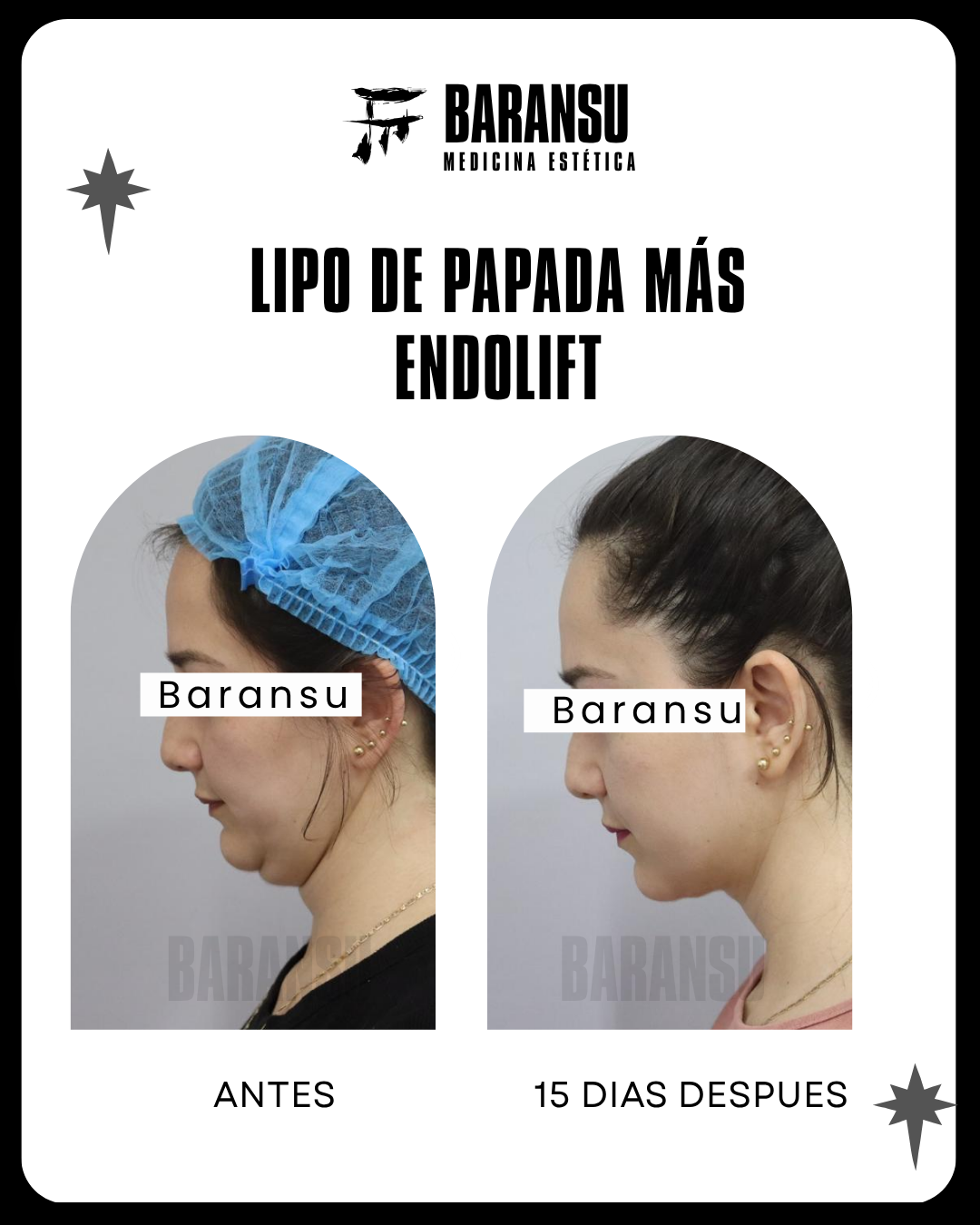 blefaroplastia 9