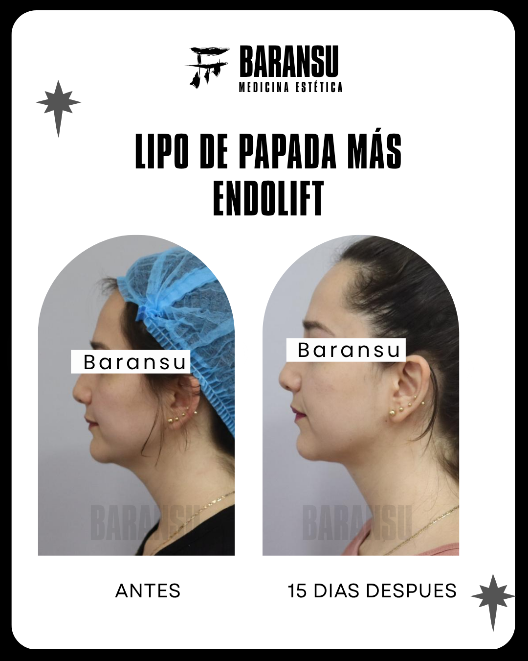 blefaroplastia 10