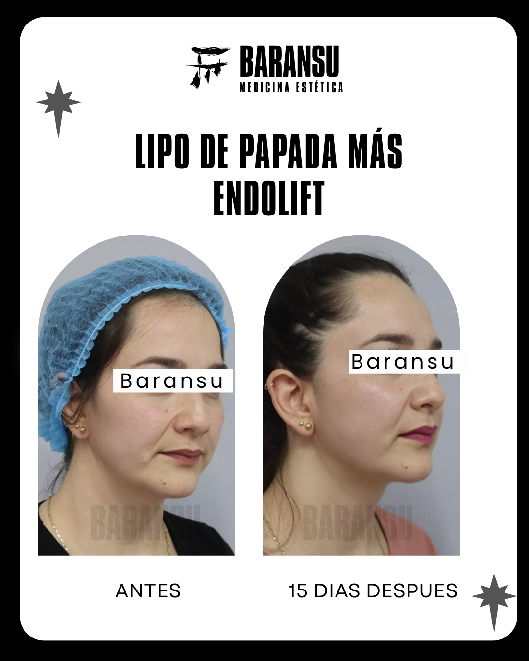 blefaroplastia 11