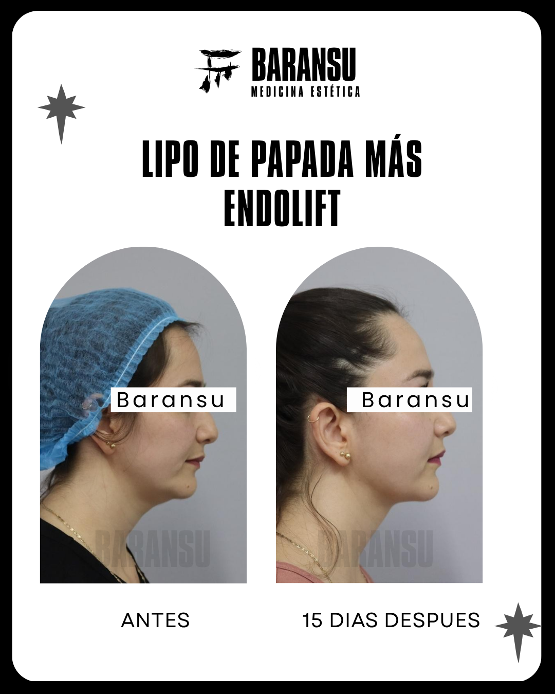 blefaroplastia 12