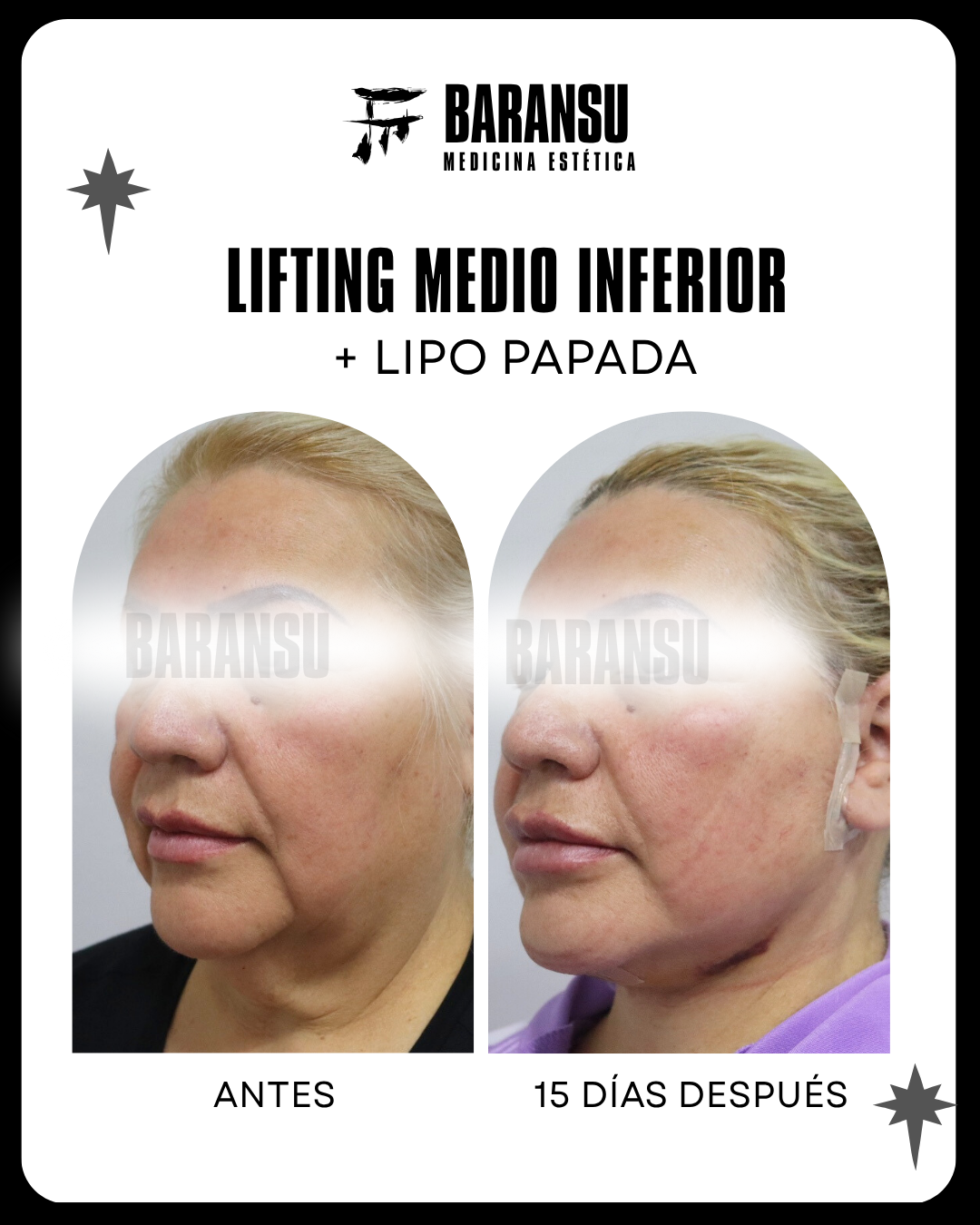 Lifting Medio Inferior Facial + Lipo Papada 8