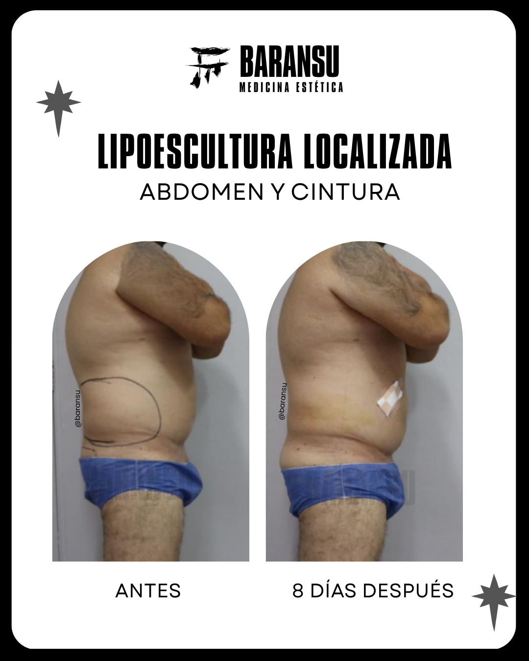 Lipoescultura Localizada (Minilipo) 13