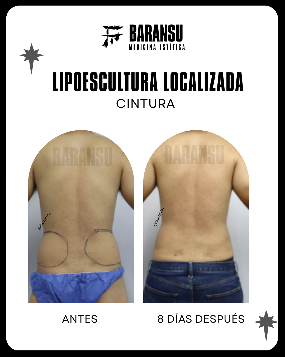 Lipoescultura Localizada (Minilipo) 16