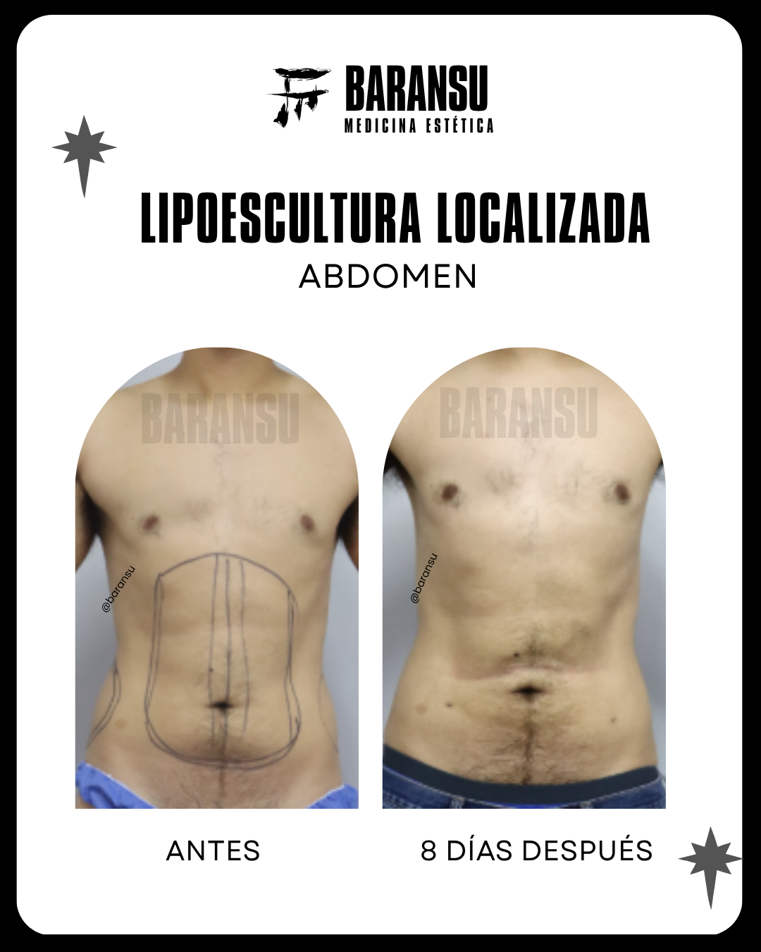 Lipoescultura Localizada (Minilipo) 17