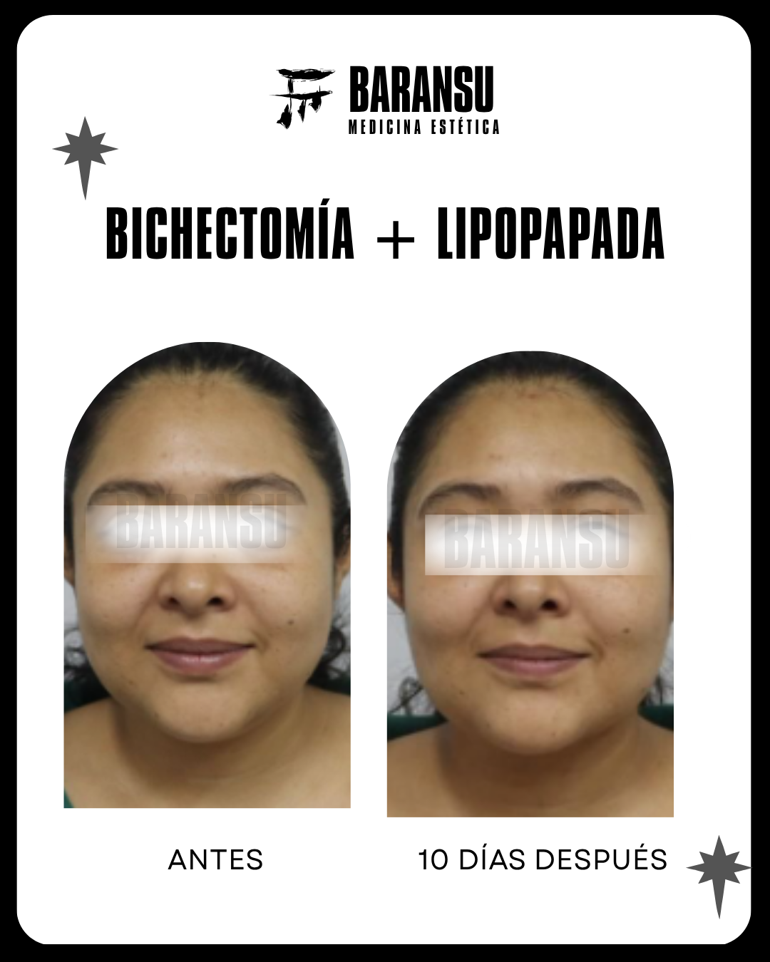 bichectomia 13