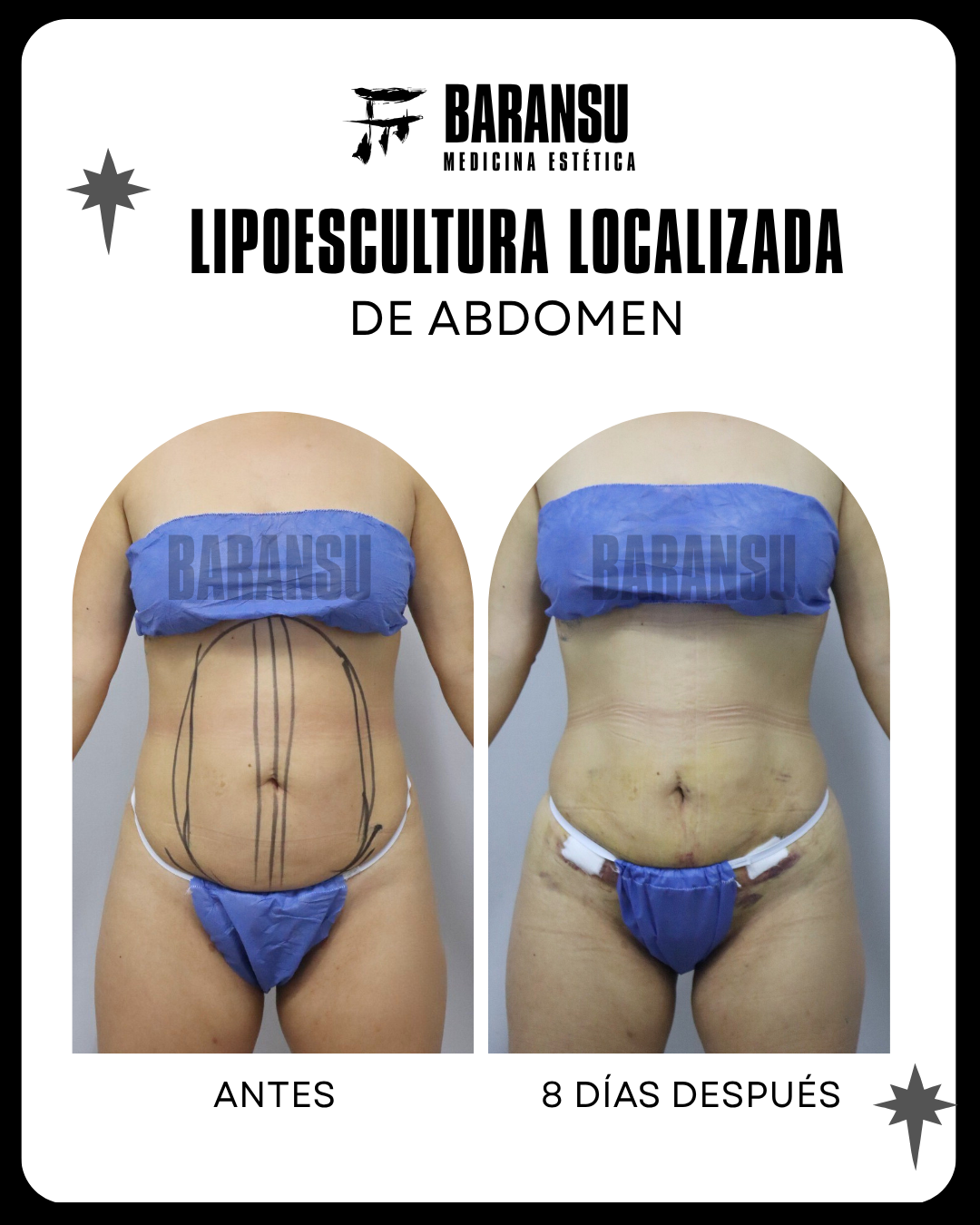 Lipoescultura Localizada (Minilipo) 20