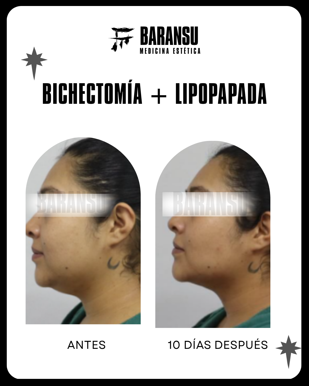 bichectomia 14