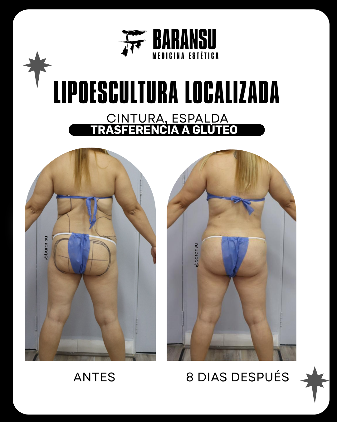 Lipoescultura Localizada (Minilipo) 1 5