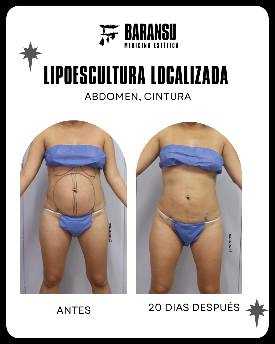 Minilipo Corporal 10