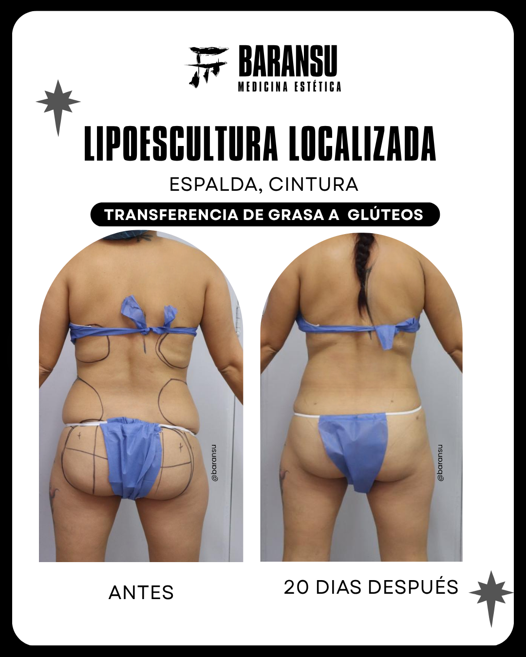 Minilipo Corporal 12