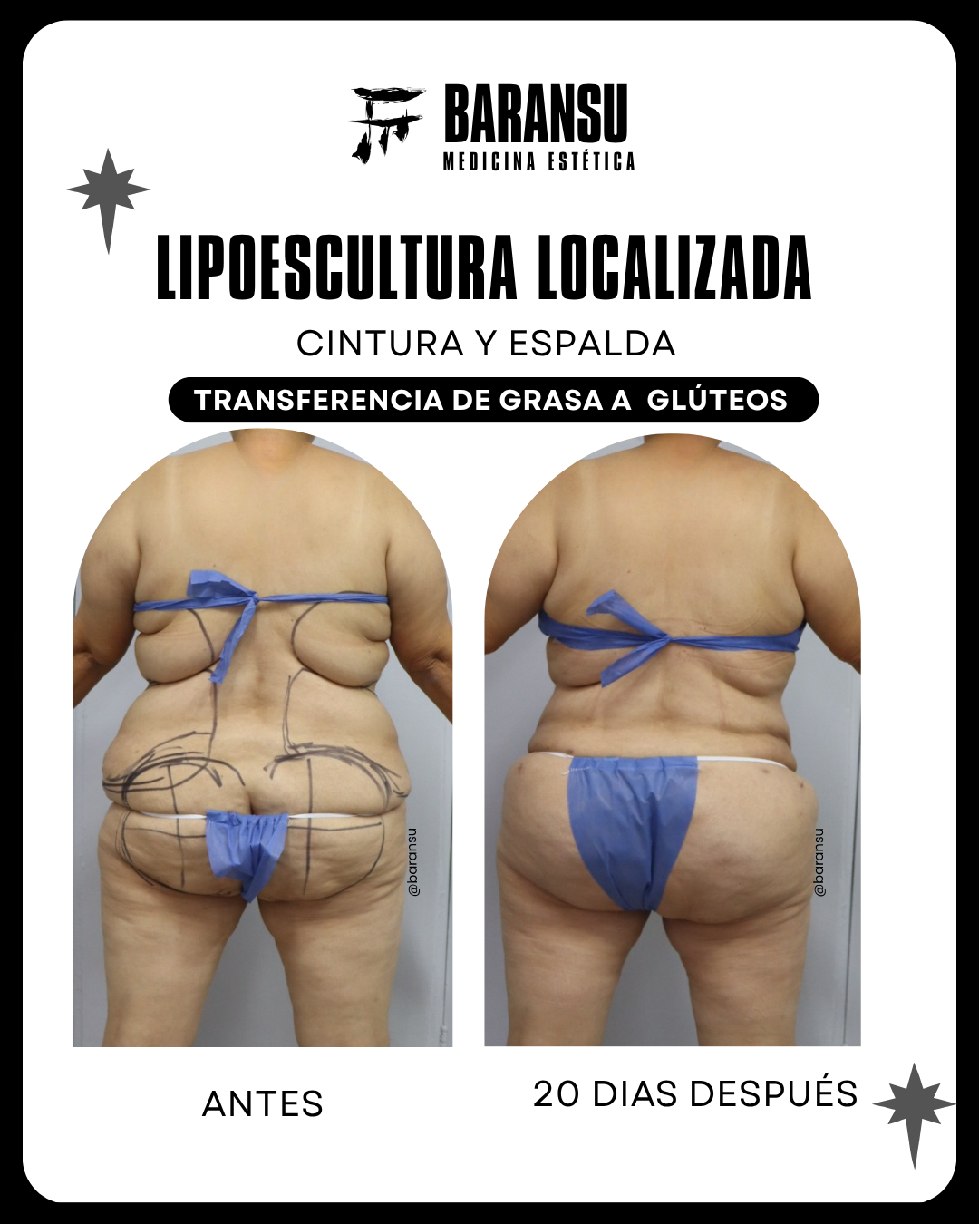 Minilipo Corporal 13