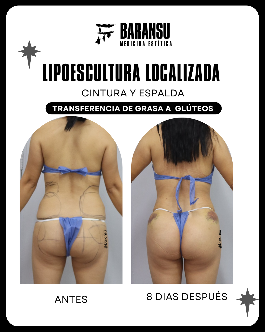Minilipo Corporal 14