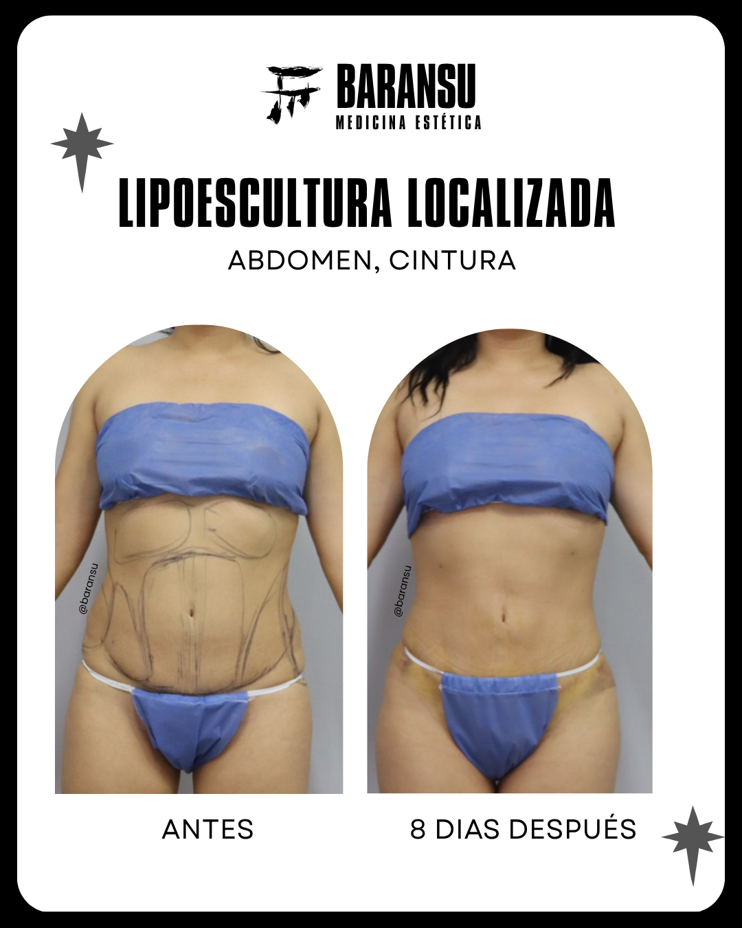 Minilipo Corporall 17