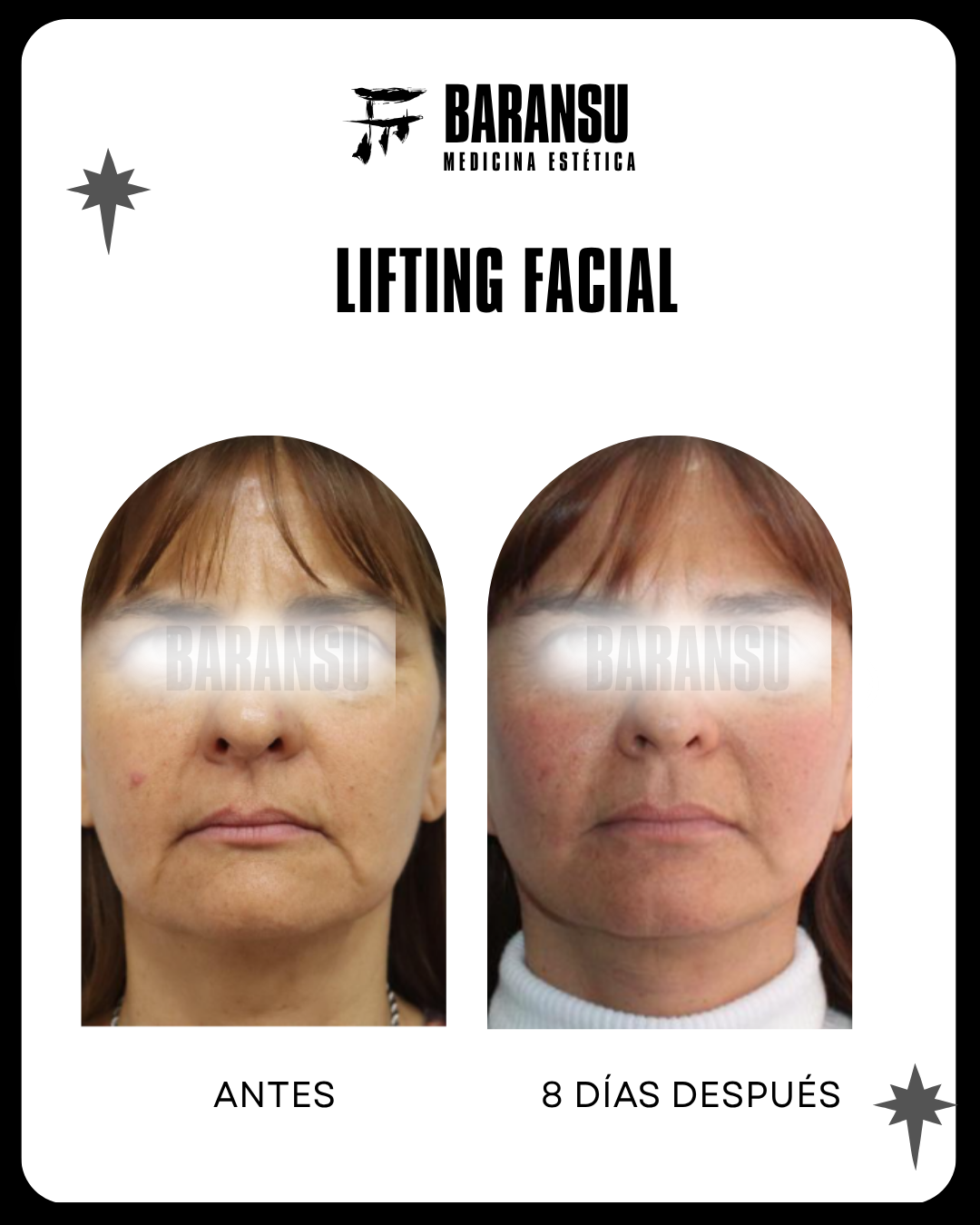 Lifting Facial 22