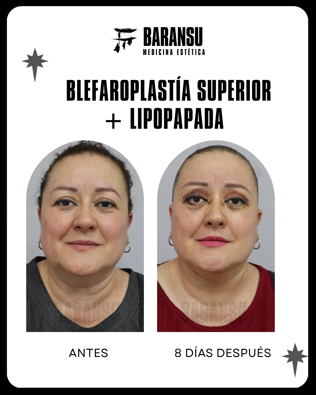 Blefaroplastía Superior + Lipo de Papada 23