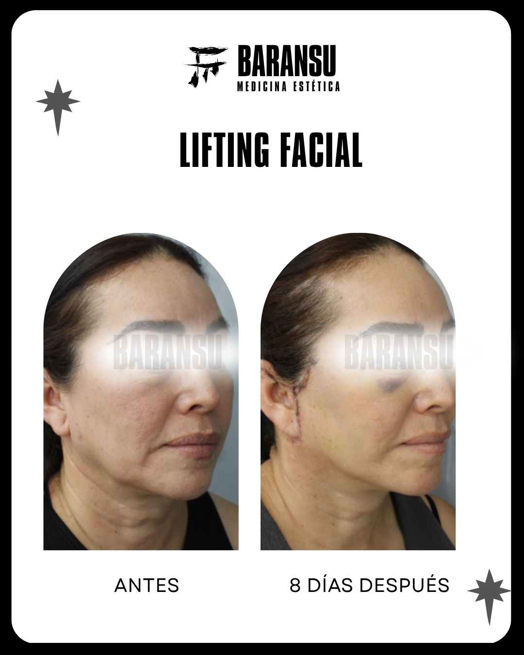Lifting Facial 24