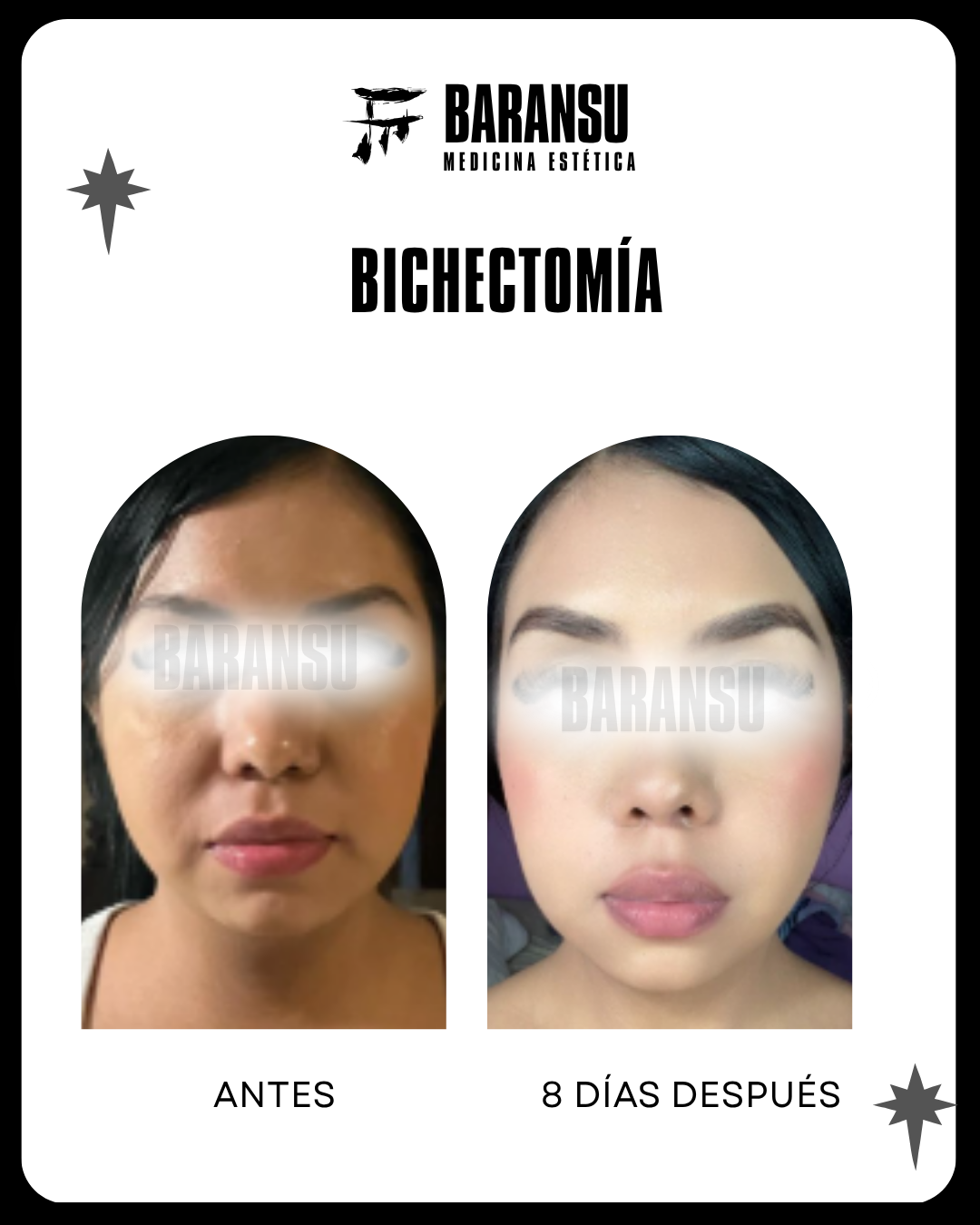 Bichectomía 16