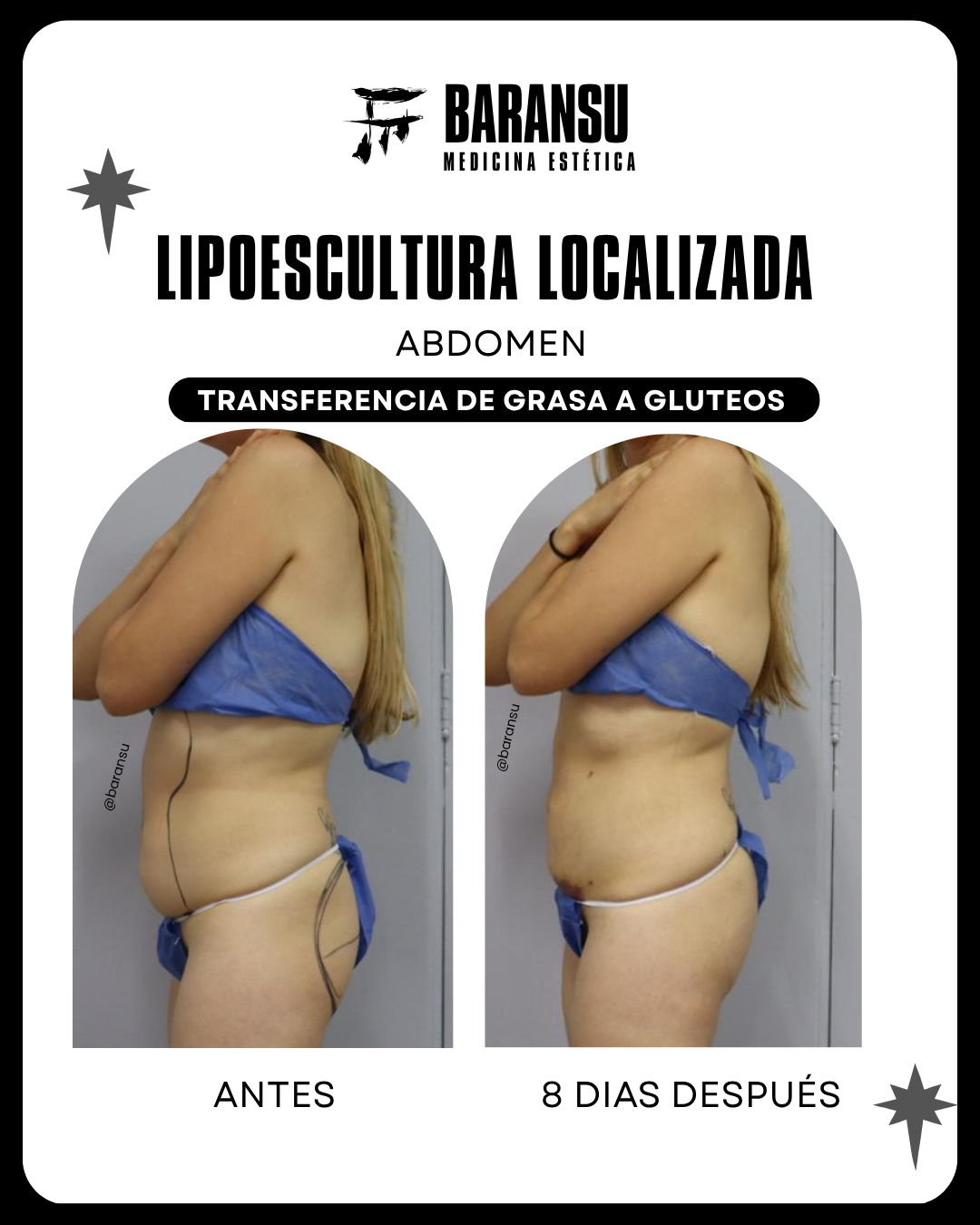 Minilipo Corporal 22
