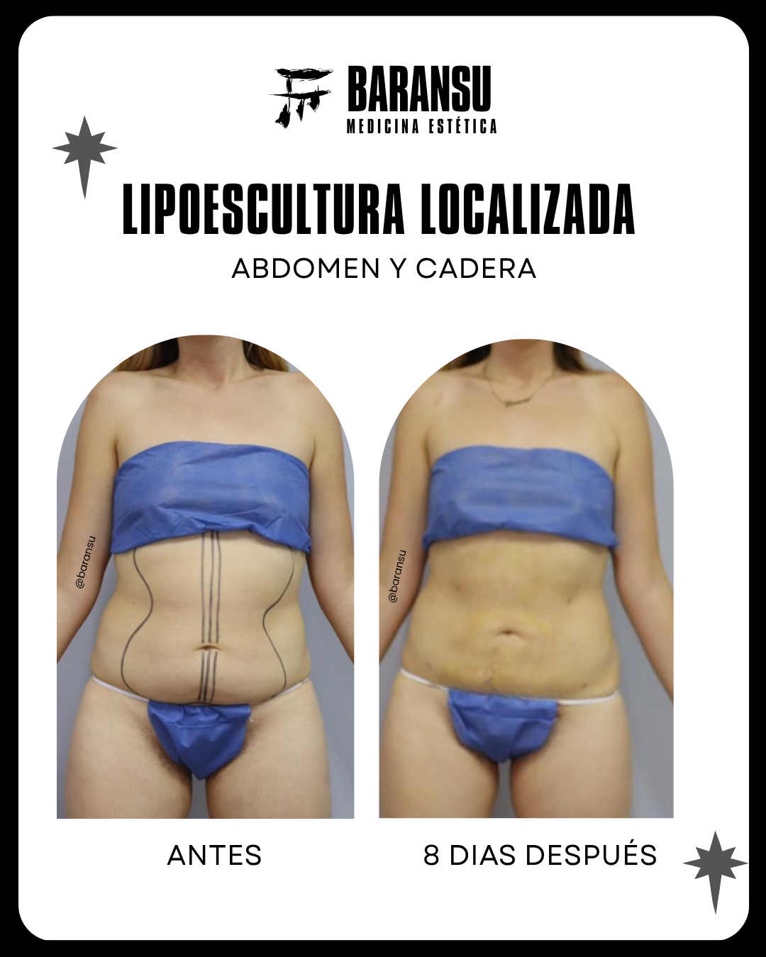 Minilipo Corporal 23