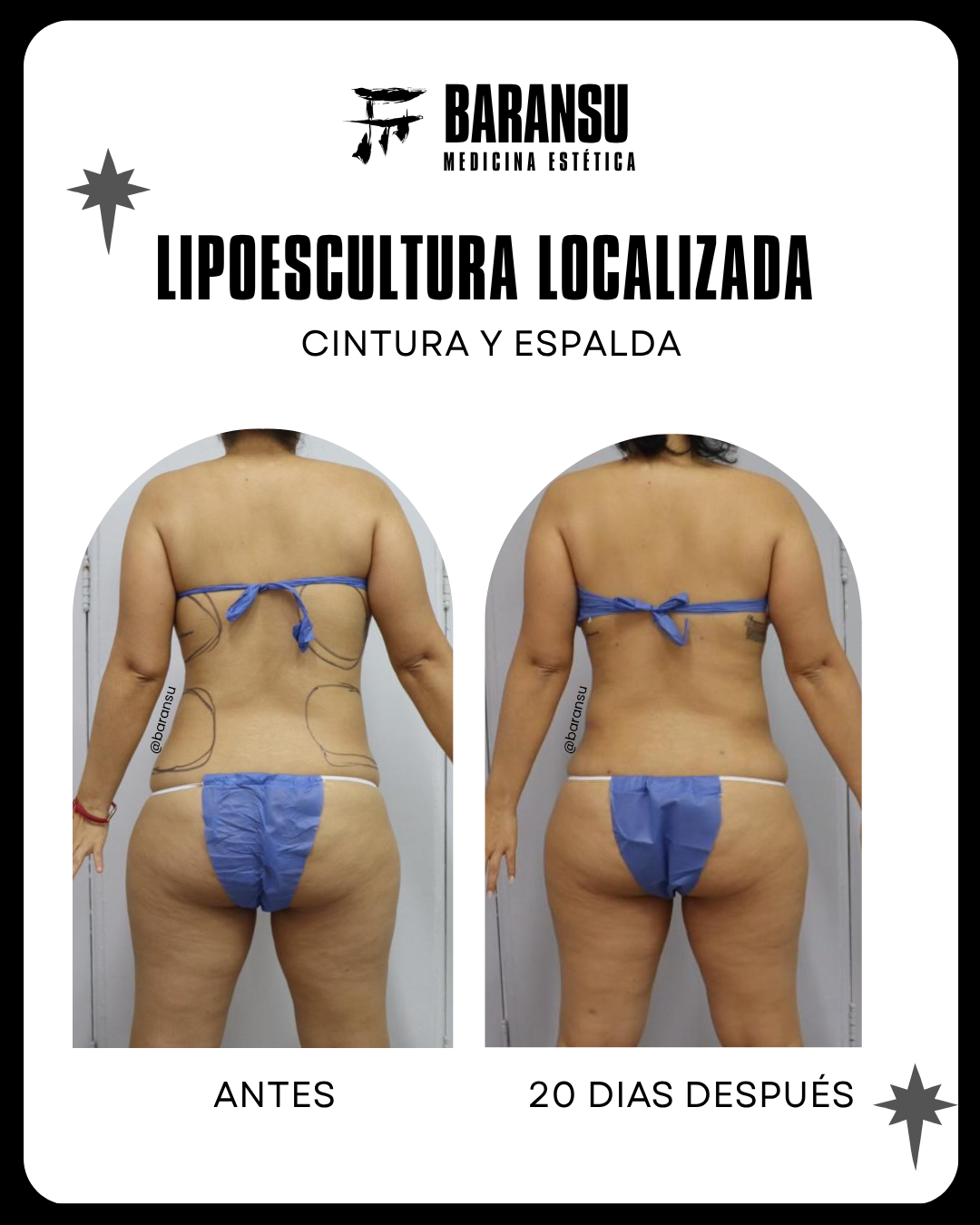 Minilipo Corporal 24