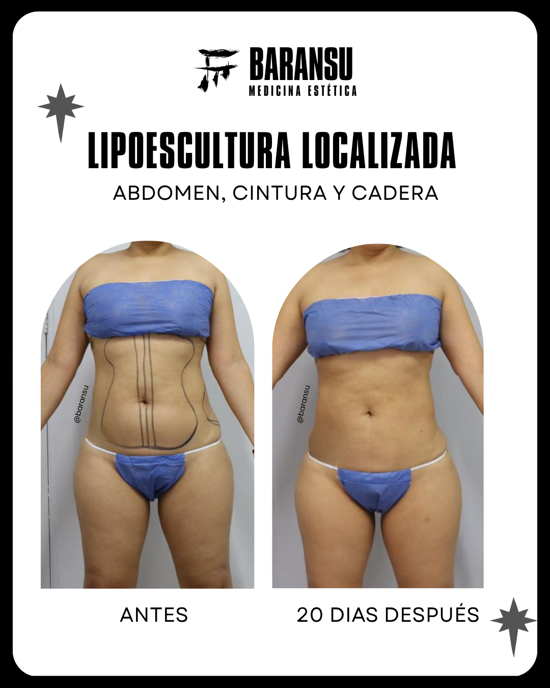 Lipoescultura Localizada (Minilipo) 39