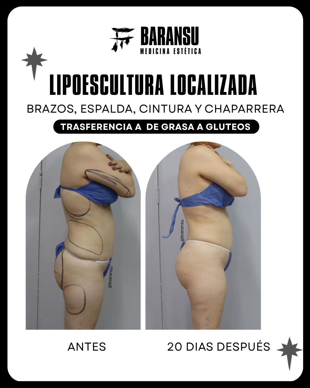 Lipoescultura Localizada (Minilipo) 41