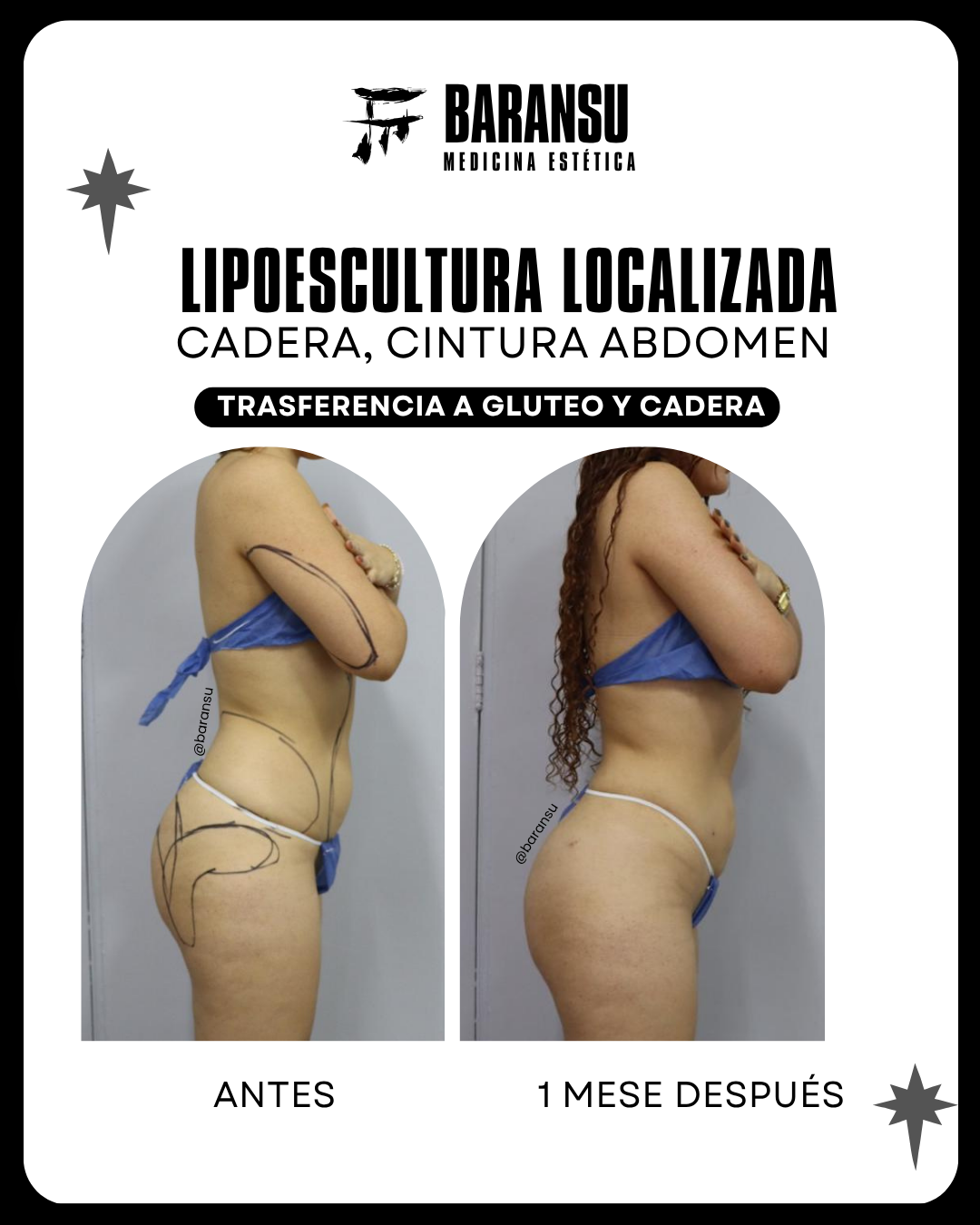 Lipoescultura Localizada (Minilipo) 43