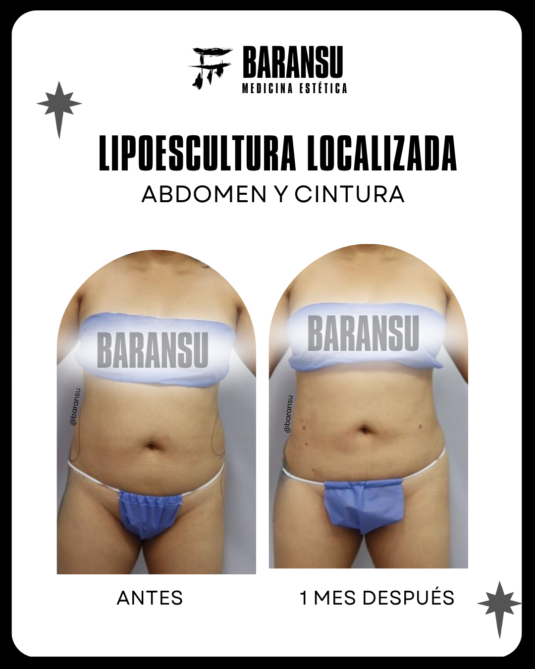 Lipoescultura Localizada (Minilipo) 47