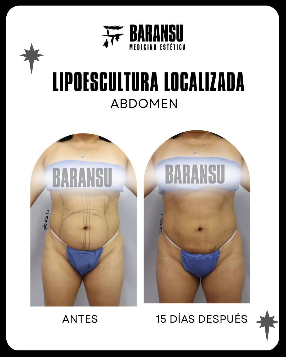 Lipoescultura Localizada (Minilipo) 49