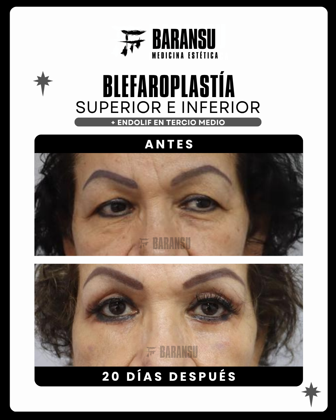 Blefaroplastía Superior e Inferior + Endolif en Tercio Medio 25