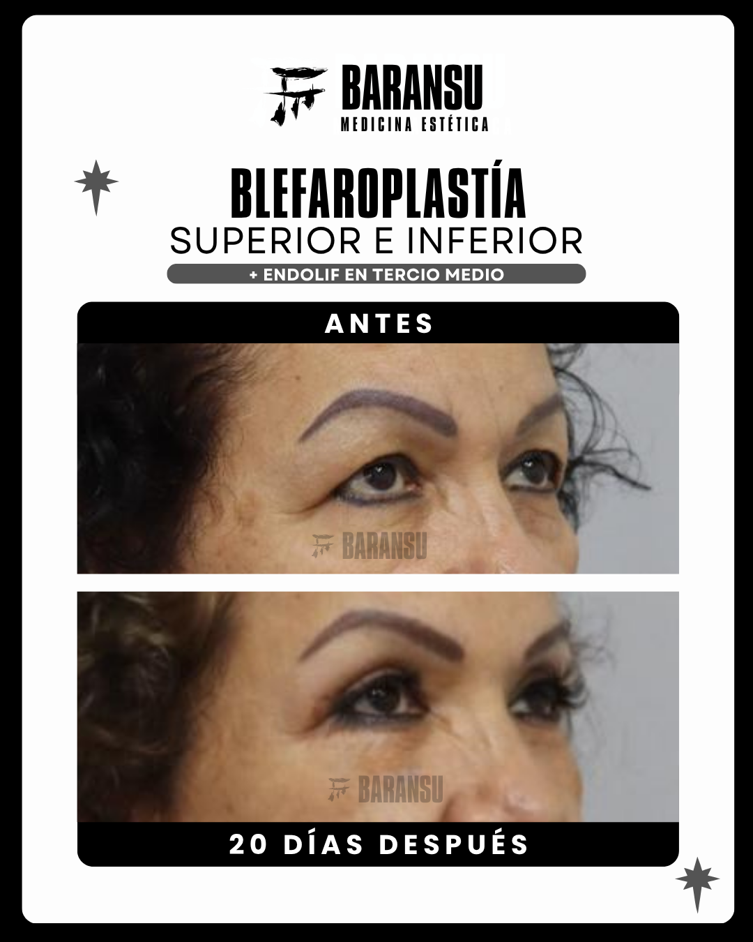 Blefaroplastía Superior e Inferior  26