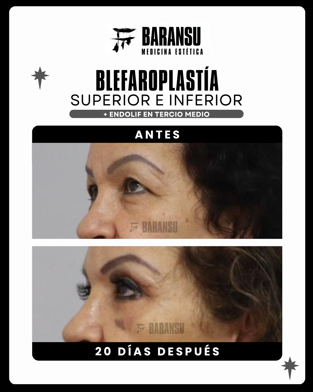 Blefaroplastía Superior e Inferior 27