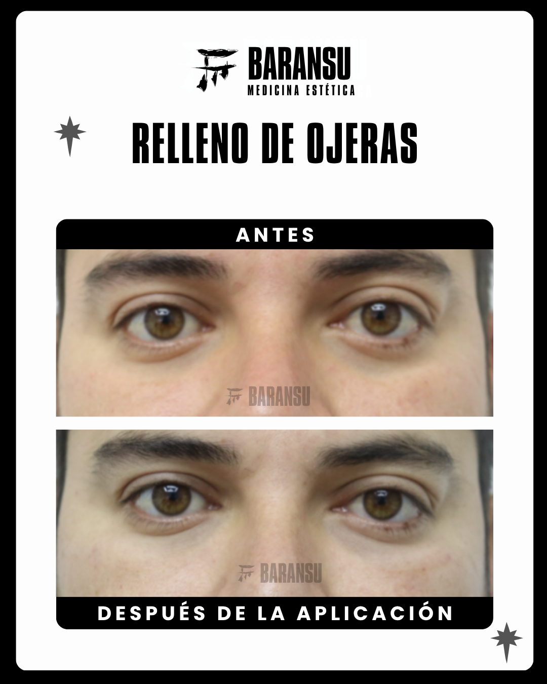 Relleno de Ojeras