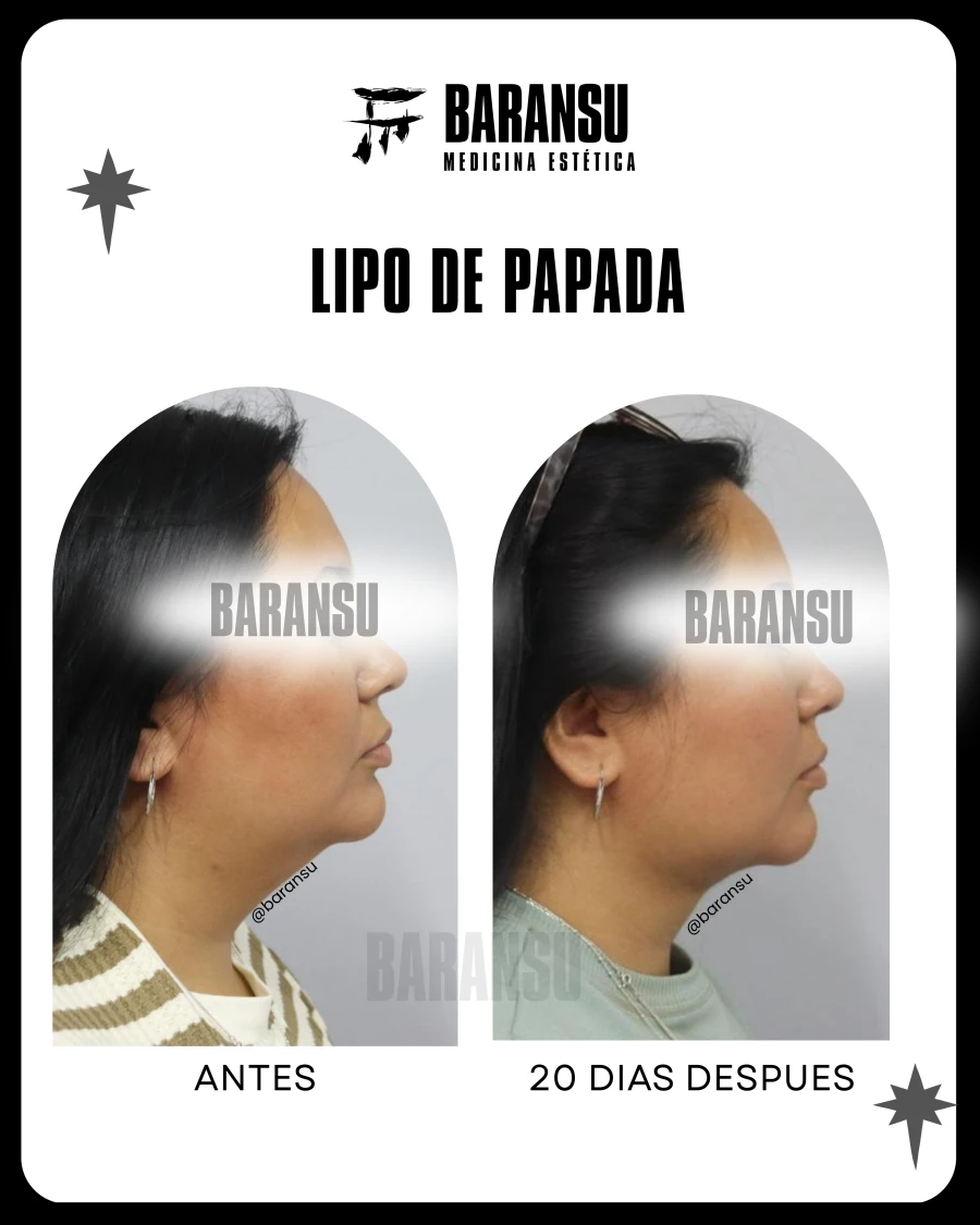 Lipo de Papada