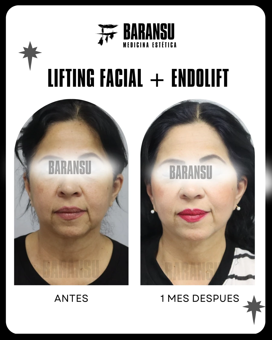 Lifting Facial