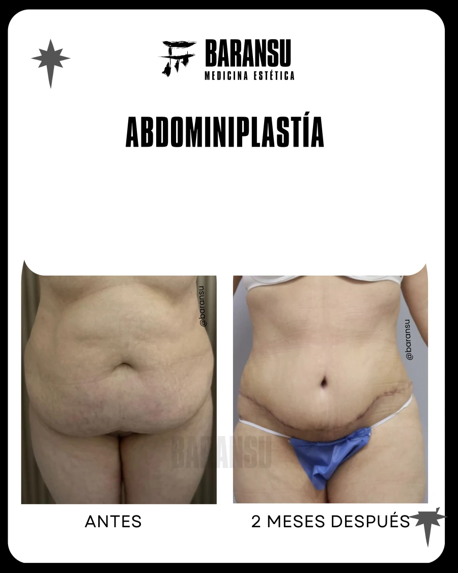 Abdominoplastía
