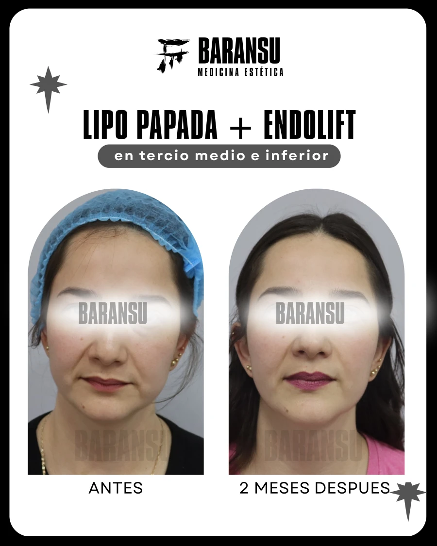 Lipo de Papada + Endolift 23