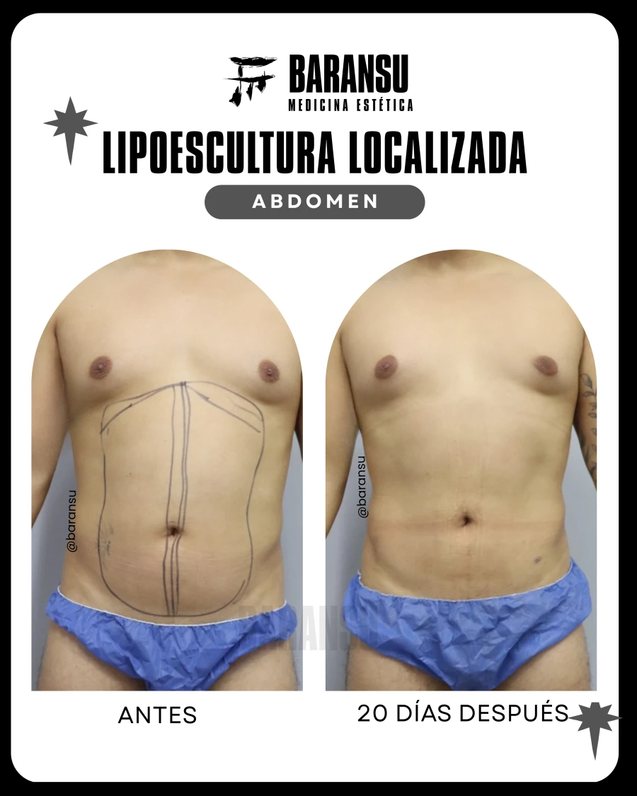 Lipoescultura Localizada (Minilipo) 51