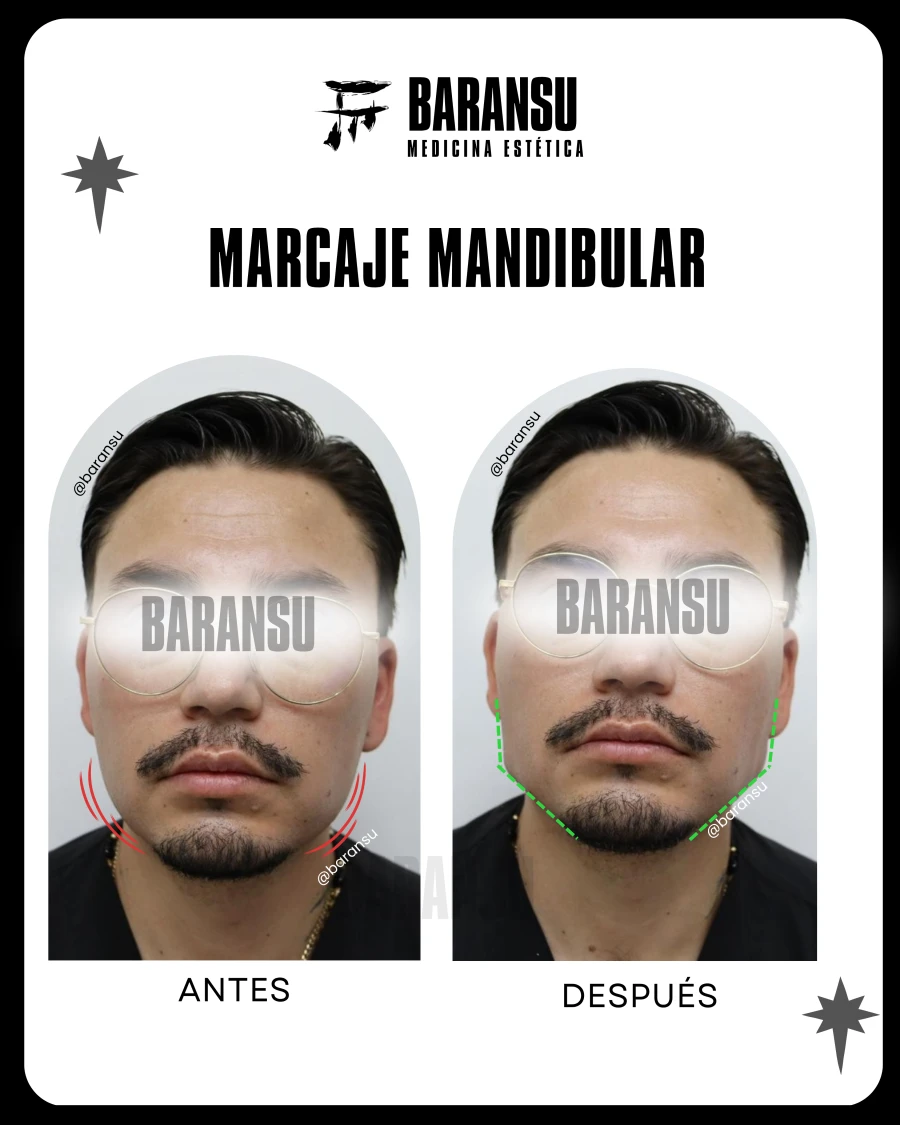 Perfilamiento Mandibular