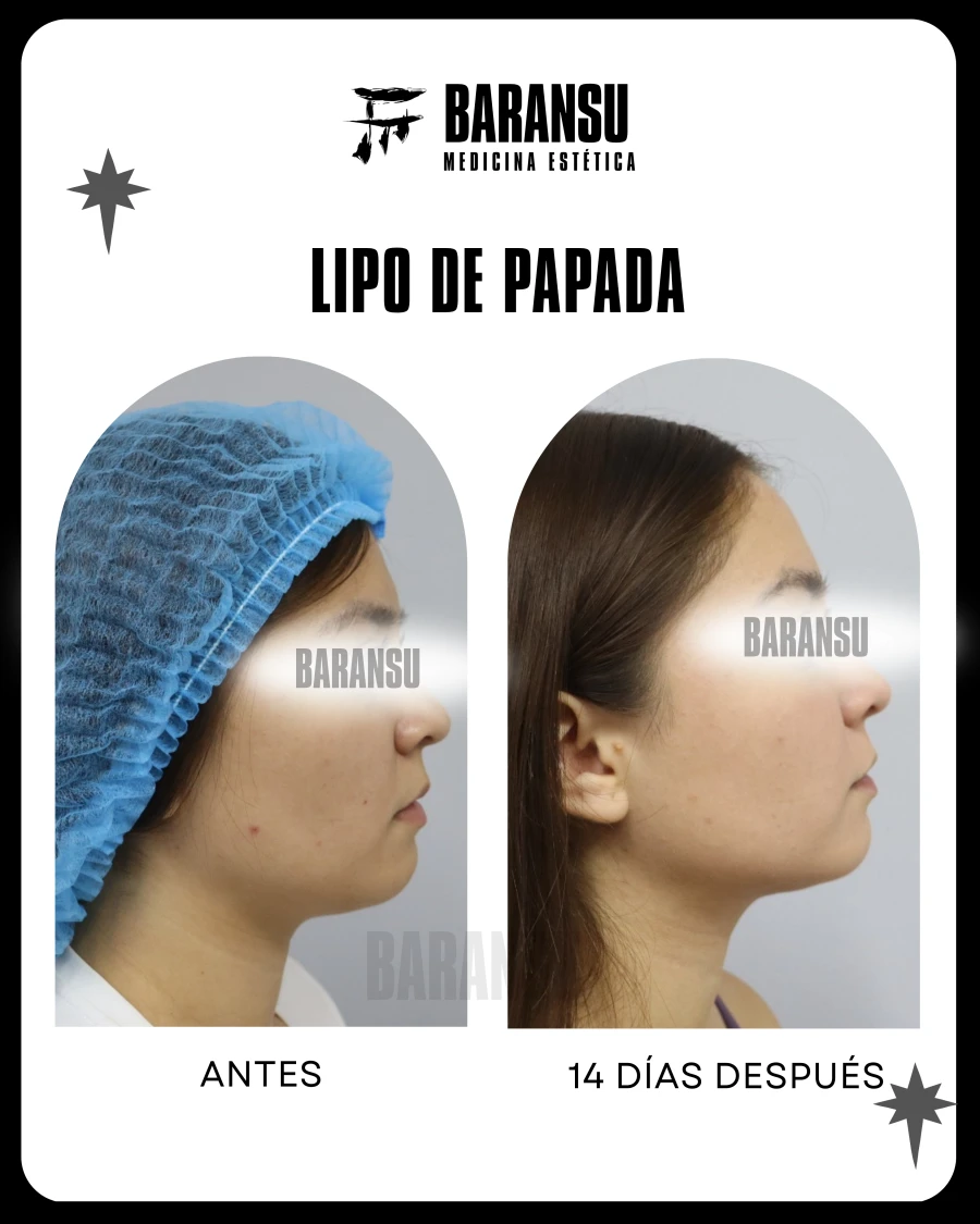 Lipo de Papada 22