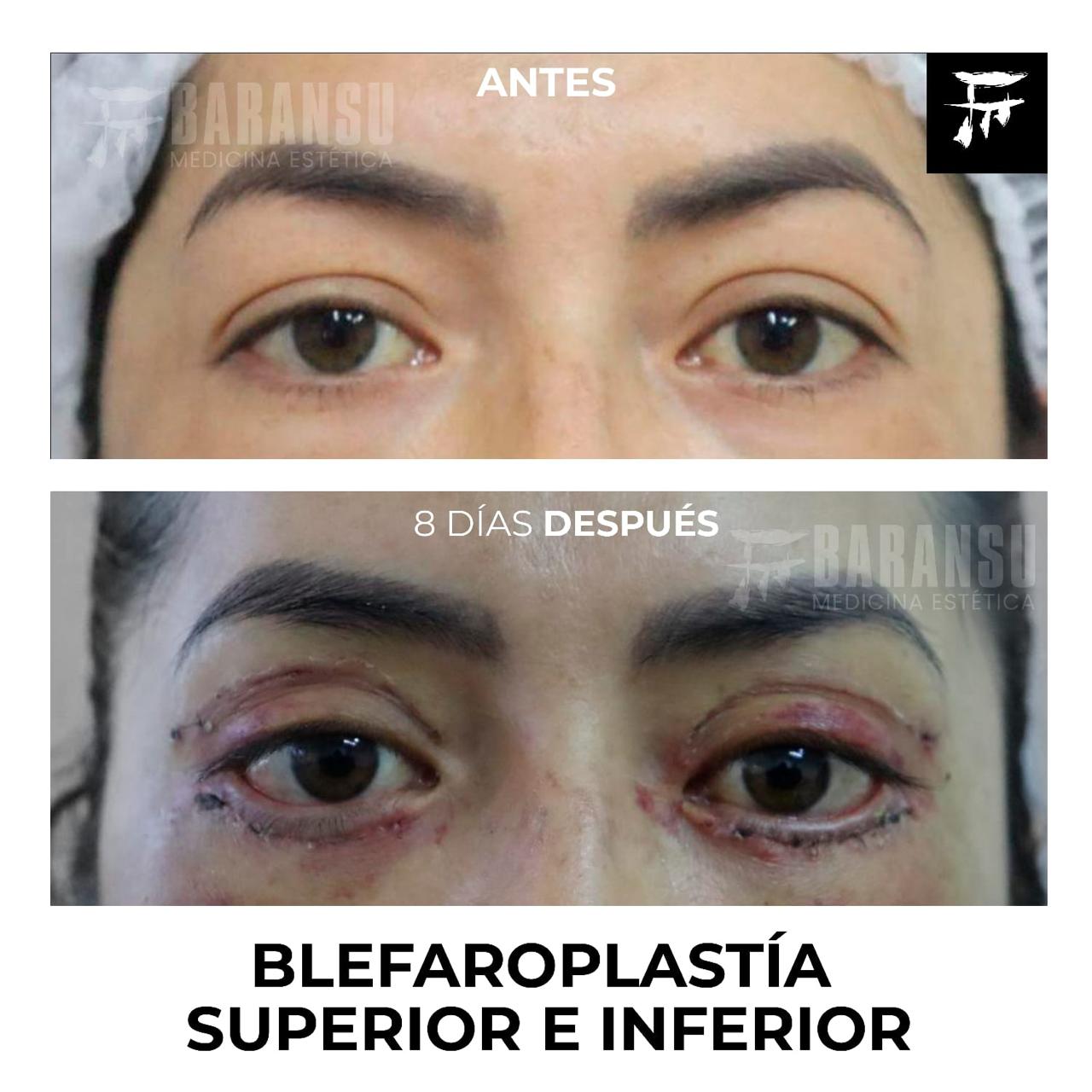Blefaroplastía Superior e Inferior 28