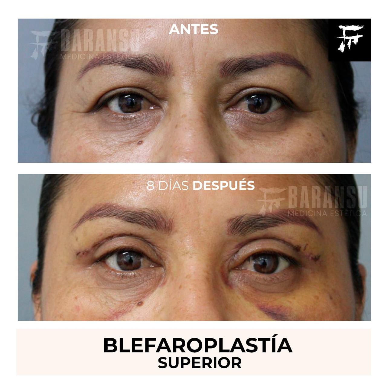 Blefaroplastía Superior 29