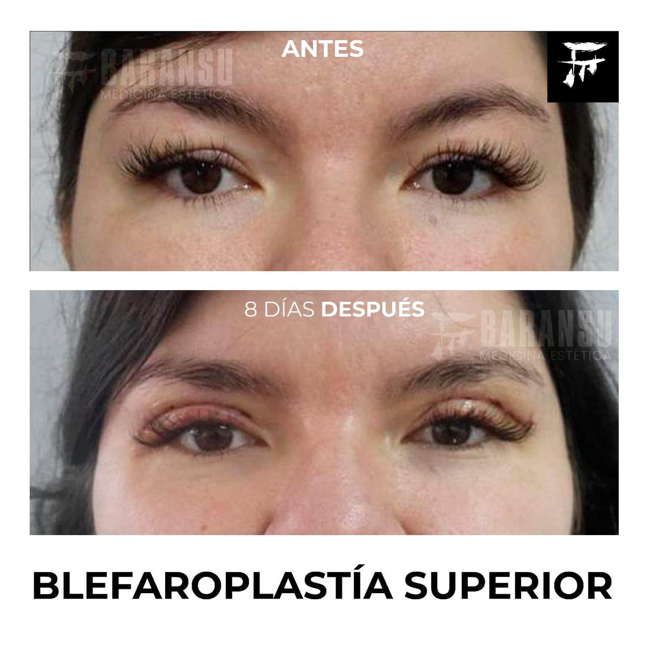 Blefaroplastía Superior 30