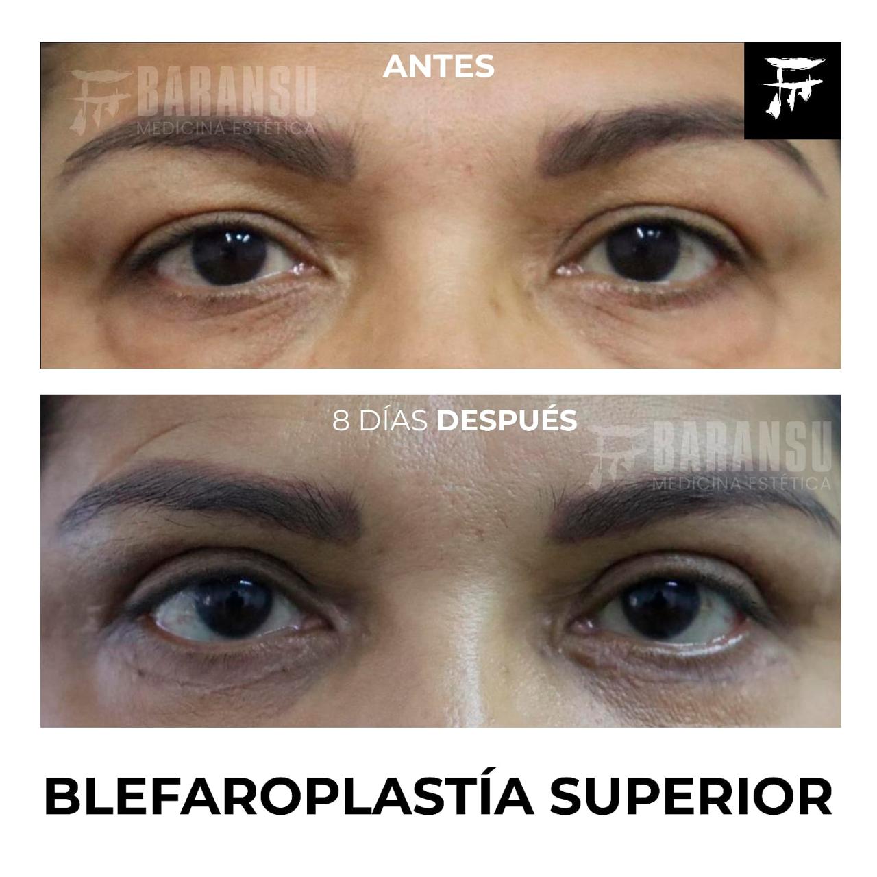 Blefaroplastía Superior 31