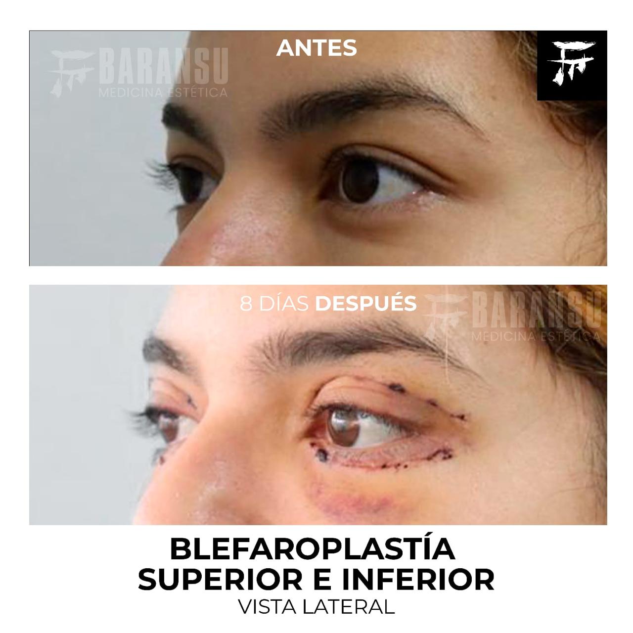 Blefaroplastía Superior e Inferior 32