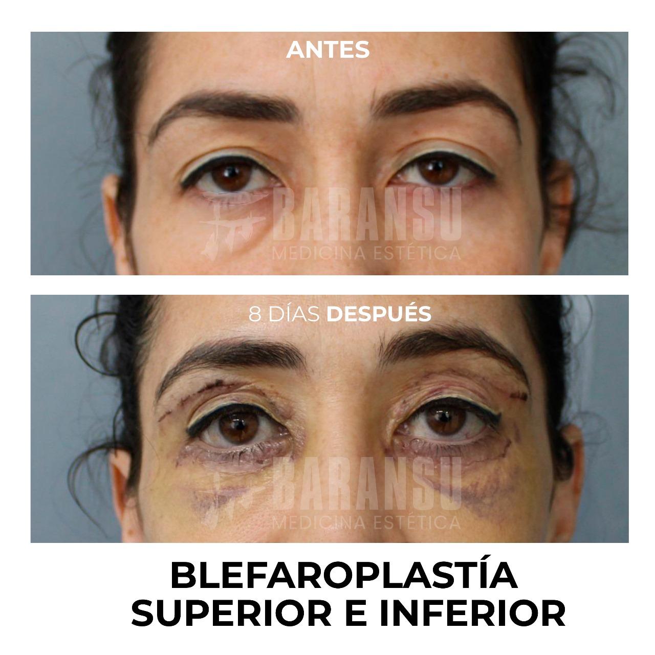 Blefaroplastía Superior e Inferior33