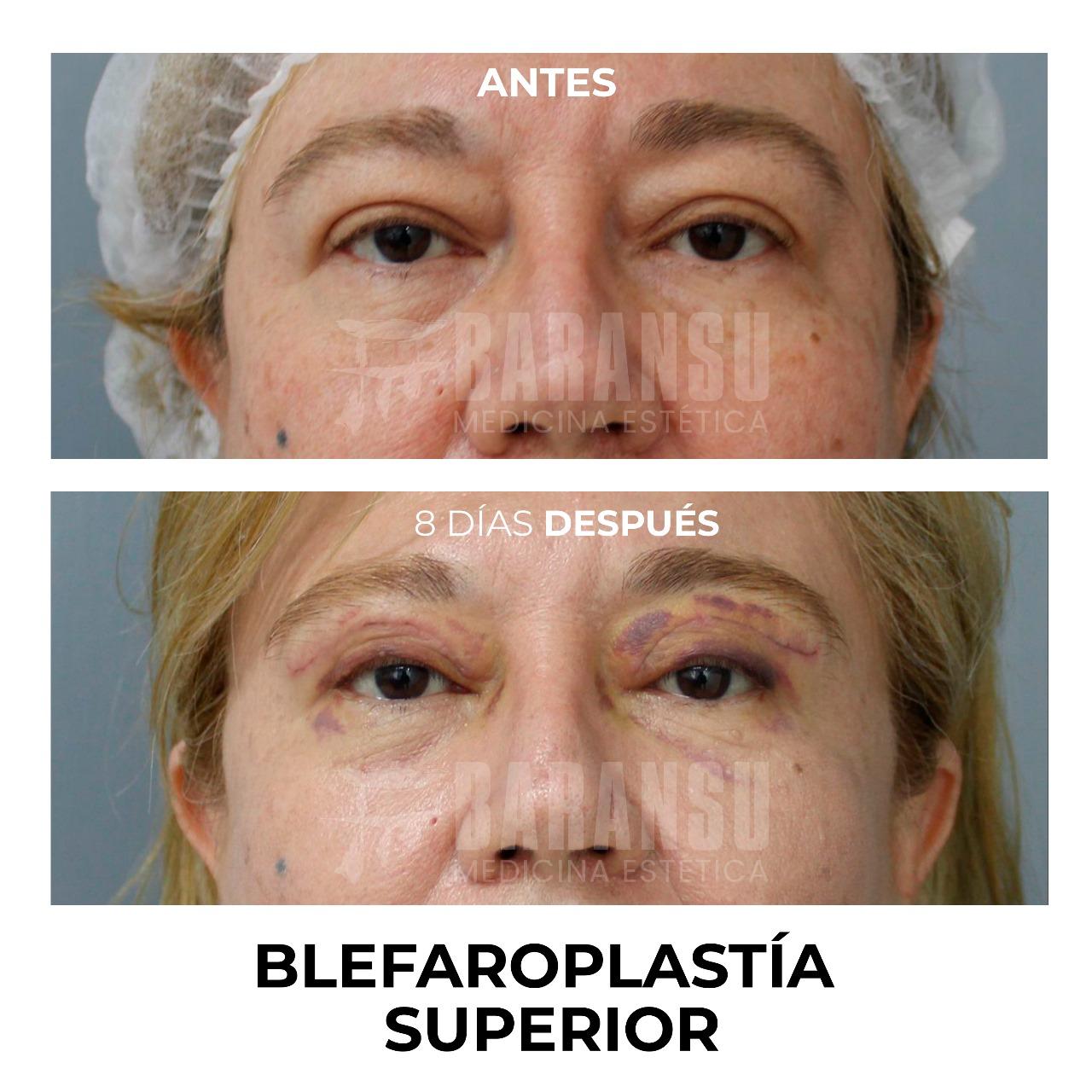 Blefaroplastía Superior 34