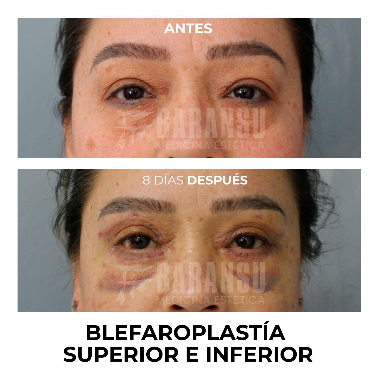 Blefaroplastía Superior e Inferior 35